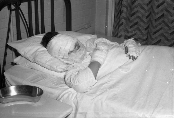 Unidentified injured boy in hospital bed after surviving a quarry blast while playing with stolen dynamite, loaded into "trench motar" made of BB shot, and used as "bombs" or "hand grenades." The boys are Robert Rasmussen, 11, son of Mr. and Mrs. Harry Rasmussen, 2928 McKinley Street; Donald Peterman, 12, son of Mr. and Mrs. T.B. Peterman, 401 Ridge Street; and Darold Olds, 14, son of Mr. and Mrs. William Olds, 421 Ridge Street.