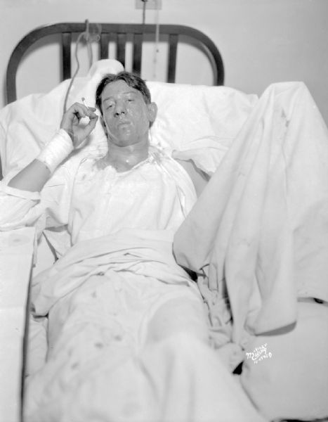 Lymon Schley, cottage fire burn victim, smoking a cigarette in the hospital.