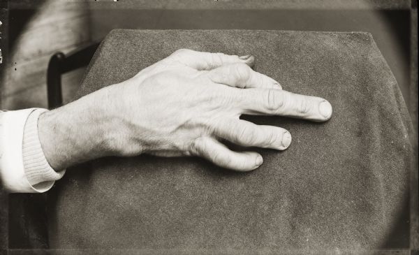 H.H. (Henry Hamilton) Bennett's damaged hand, which was sustained in the Civil War and permanently crippled his right hand.