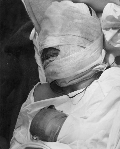 Sgt. Vincent Brencick, USMC, IV Division, commander and sole survivor of the crew of the General Sherman tank <i>Capetown</i>, set afire by a mine. Sgt. Brencick is almost completely wrapped in bandages. His civilian occupation was apprentice butcher in St. Louis, MO.