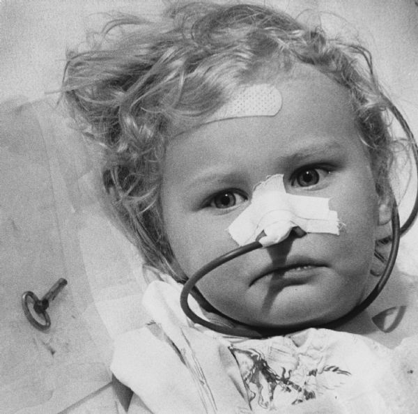 A small child is laying in a bed and staring intently. A breathing tube is taped to her nose, and an adhesive bandage is on her forehead. Next to her is a key. Caption reads: "A mystery was solved when 21-month-old Melissa, daughter of Mr. and Mrs. David F. Roenspies, 6630 W. Hampton Av., was operated on at Mount Sinai hospital Tuesday. An abdominal incision disclosed that she had swallowed a key (left) last Saturday and that it had caused a choking spell. A hasty search of the house had found no known keys missing. Melissa was reported to be recovering satisfactorily."